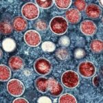 Sweden confirms first case of mpoxSweden confirms first case of mpox 